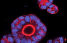 ep cientificosirb logran predecirmetastasiscancer colon ep cientificosirb logran predecirmetastasiscancer colon