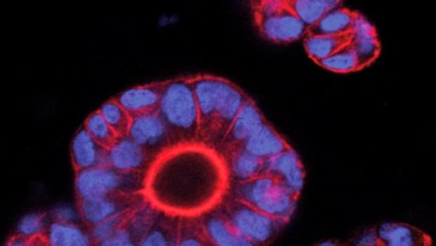 ep cientificosirb logran predecirmetastasiscancer colon