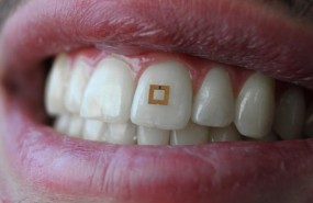 ep implante dental