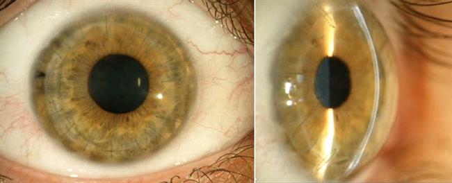 ep corneatrasplantecornea