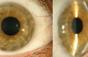 ep corneatrasplantecornea