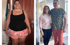 manga gastrica turquia antes despues