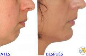 1574764323 mentoplastia