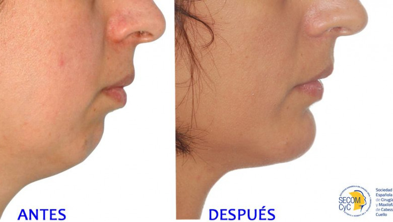 1574764323 mentoplastia