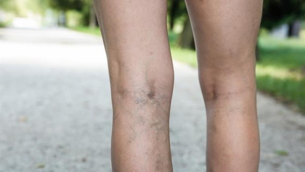ep varices