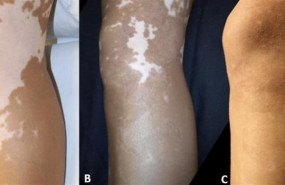 ep vitiligo