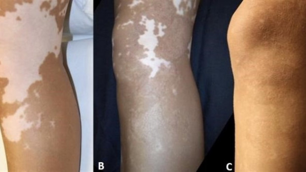 ep vitiligo