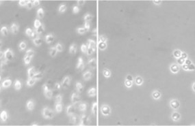 ep linfoma