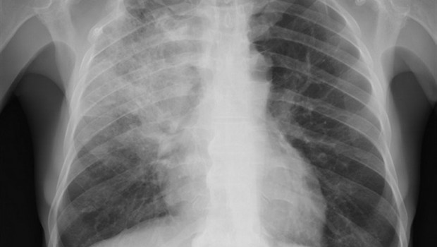 ep neumonia pulmonia radiografia pulmones 20190523130516