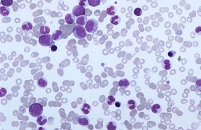 ep leucemia
