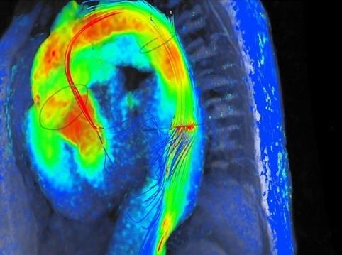 Resonancia magnética cardiaca 4D | QUIRONSALUD MADRID ep resonancia magnetica cardiaca 4d