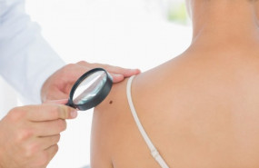 ep lunares cancer de piel melanoma