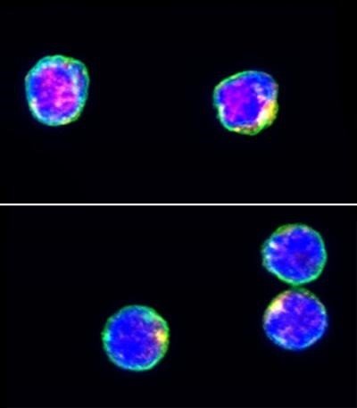 La imagen de inmunofluorescencia muestra CD3 (verde), Tet2 (rojo) y DAPI (azul) en células T CD4 + humanas de la sangre periférica de individuos con diabetes tipo 1 recientemente diagnosticada (abajo) e individuos sin diabetes tipo 1 (arriba). | CAROLIN DANIEL, HELMHOLTZ ZENTRUM MÜNCHEN ep la imagen de inmunofluorescencia muestra cd3 verde tet2 rojo y dapi azul en celulas t cd4 humanas
