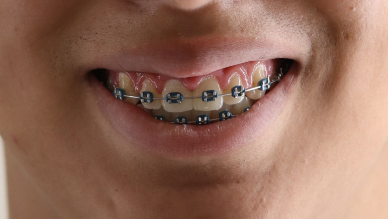 sonrisa brackets murcia ortodoncia lozano 