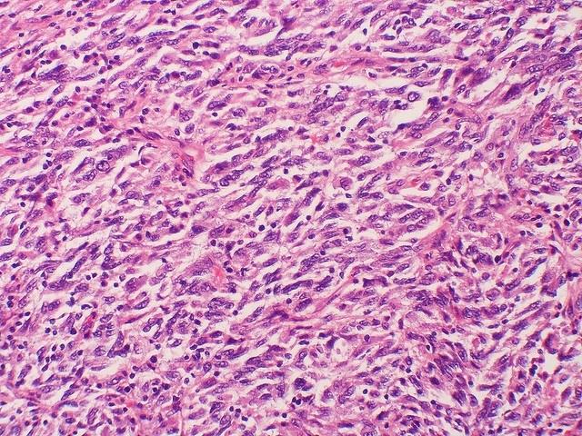 ep metastasis melanoma cancer
