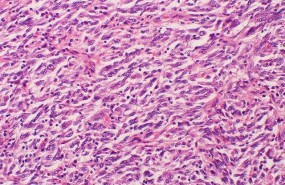 ep metastasis melanoma cancer