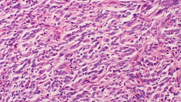 ep metastasis melanoma cancer
