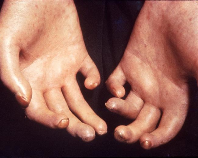 ep esclerodermia