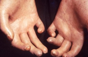 ep esclerodermia