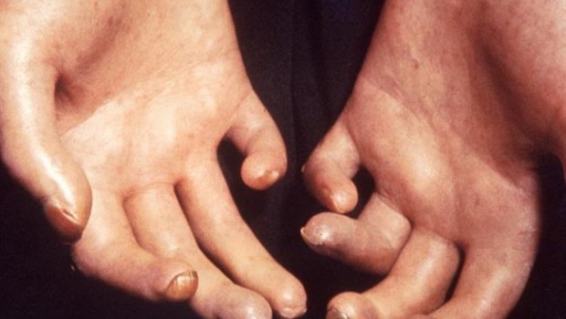 ep esclerodermia