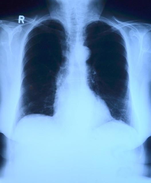 Pulmones, radiografía | PIXABAY ep pulmones radiografia