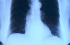 ep pulmones radiografia
