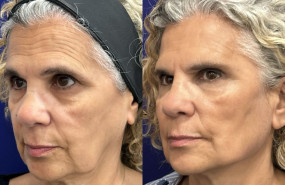 antesydespus globalface antesydespus globalface