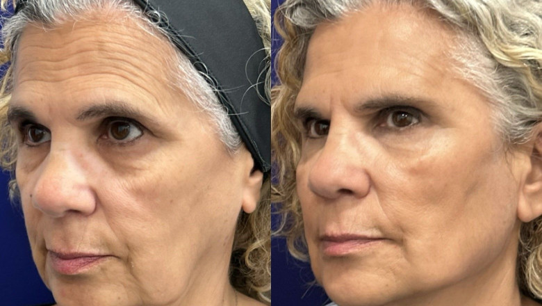 antesydespus globalface 