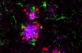 ep la proteina amiloide magenta es visiblelas placas amiloides azul rodeadascelulas inmunitarias llamadas microglia verde y proteina tau roja