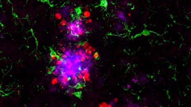 ep la proteina amiloide magenta es visiblelas placas amiloides azul rodeadascelulas inmunitarias llamadas microglia verde y proteina tau roja