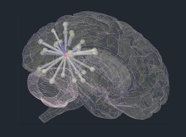 Propagación de la proteína tau en el cerebro de un paciente con Alzheimer | THOMAS COPE/CAMBRIDGE UNIVERSITY - Archivo ep propagacionla proteina taucerebroun pacientealzheimer