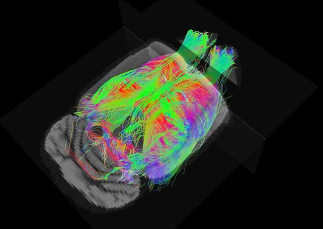 Estudio sobre la resonancia magnética en el Alzheimer | IDIPABS ep estudiola resonancia magneticaalzheimer