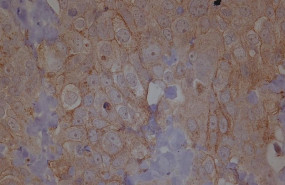 ep metastasis cancer de ovario