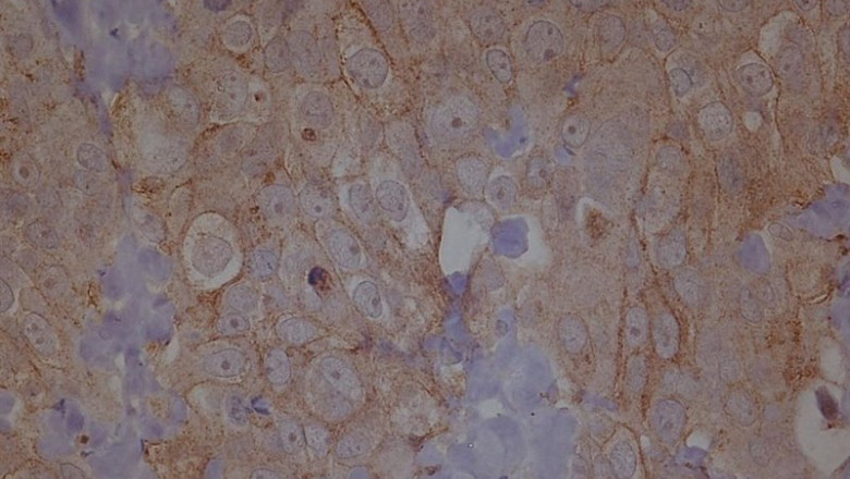ep metastasis cancer de ovario ep metastasis cancer de ovario