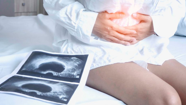 1615800245 endometriosis