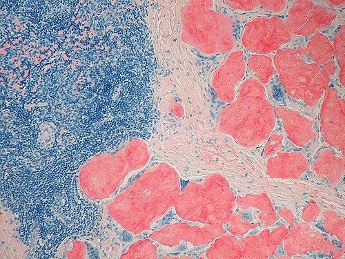ep amiloidosis