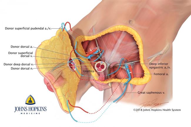 Diagrama del primer trasplante de pene y escroto en el mundo | DEVON STUART FOR JOHNS HOPKINS MEDICINE ep diagramaprimer trasplantepeneescrotomundo