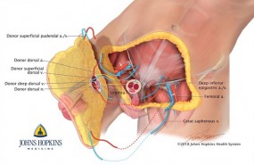 ep diagramaprimer trasplantepeneescrotomundo