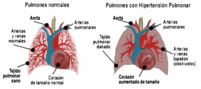 Hipertensión pulmonar arterial | FCHP ep hipertension pulmonar arterial
