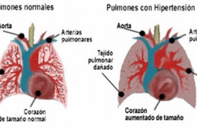 ep hipertension pulmonar arterial