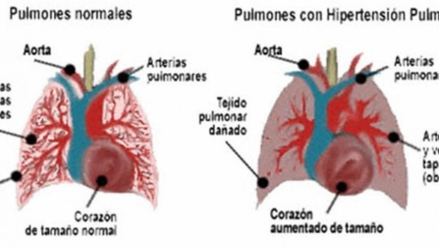 ep hipertension pulmonar arterial