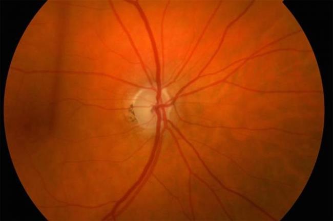 ep glaucoma 20180320175502