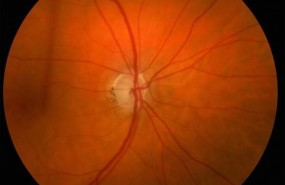 ep glaucoma 20180320175502