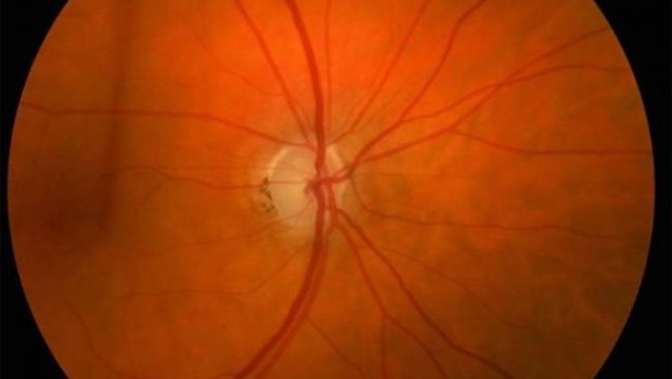 ep glaucoma 20180320175502