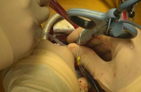 ep tecnicala insuficiencia mitral