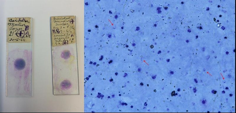 ep portaobjetos de microscopios medicos de espana en los anos 40 con sangre infectada de malaria