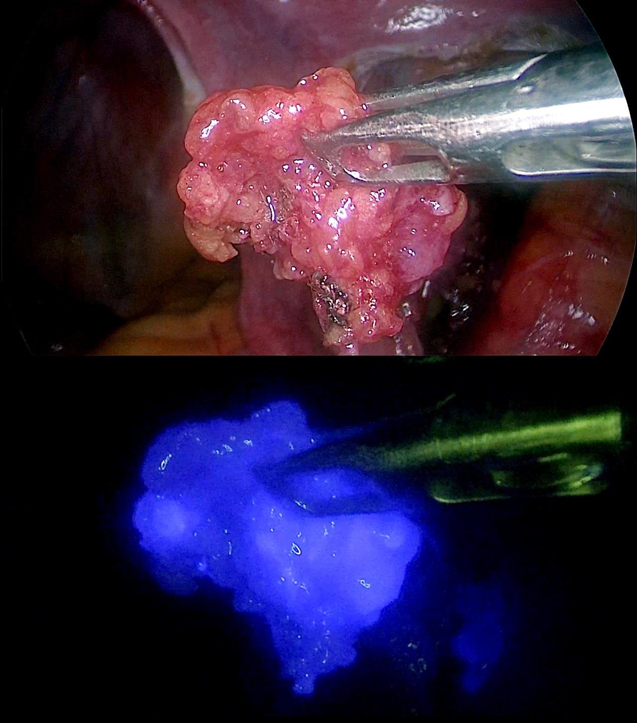 Radiación y fluorescencia: más posibilidades para detectar el ganglio centinela | QUIRÓNSALUD ep radiacionfluorescencia mas posibilidadesdetectarganglio centinela