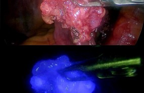 ep radiacionfluorescencia mas posibilidadesdetectarganglio centinela