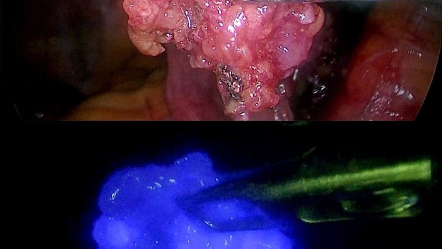 ep radiacionfluorescencia mas posibilidadesdetectarganglio centinela