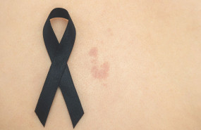 2 ndp dia europeo del cancer de piel 